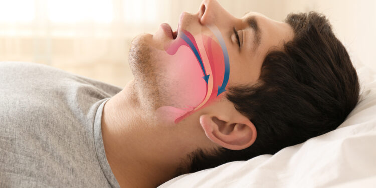 Centrinės ir obstrukcinės miego apnėjos skirtumai