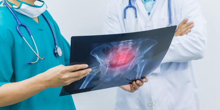 Kas yra kaulų čiulpų edema ir kaip ji gydoma?