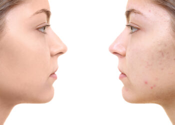 Kodėl atsiranda baltų dėmių ant odos ir kaip jų atsikratyti?