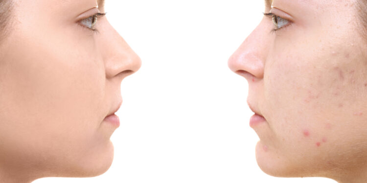 Kodėl atsiranda baltų dėmių ant odos ir kaip jų atsikratyti?