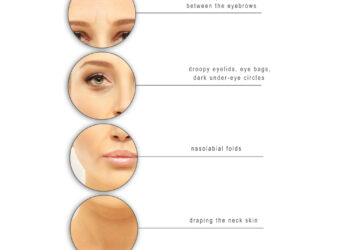 Vokų nusileidimas po botokso