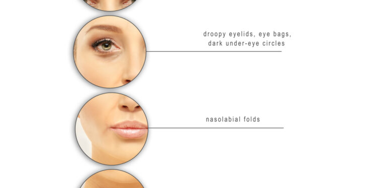 Vokų nusileidimas po botokso