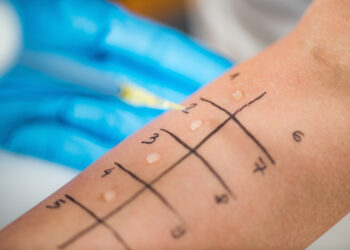 Odos pažeidimo KOH tyrimas