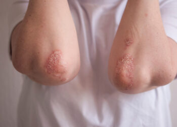 Psoriazės ankstyvosios stadijos: kokios jos?