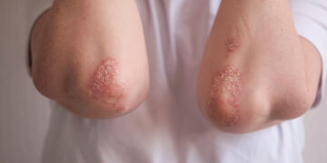 Psoriazės ankstyvosios stadijos: kokios jos?