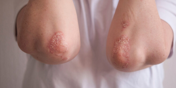 Psoriazės ankstyvosios stadijos: kokios jos?