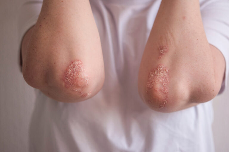 Psoriazės ankstyvosios stadijos: kokios jos?