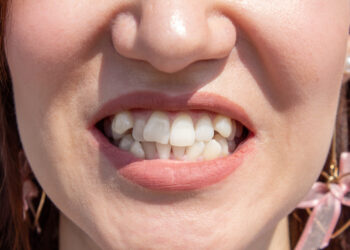 Nelygus žandikaulis