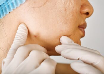 Užkrėsta spuogas: kaip atpažinti infekciją?