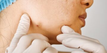 Užkrėsta spuogas: kaip atpažinti infekciją?