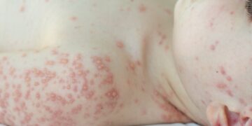 Ar dilgėlinė ir bėrimai yra užkrečiami?