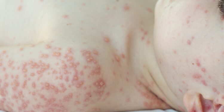 Ar dilgėlinė ir bėrimai yra užkrečiami?