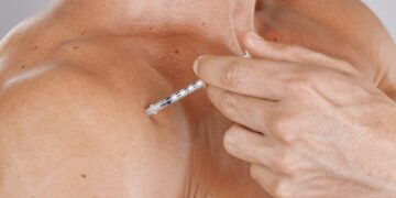 Kaip botoksas veikia raumenis?