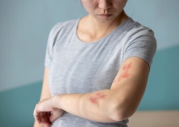 Avižinės vonios nuo niežulio dėl dilgėlinės