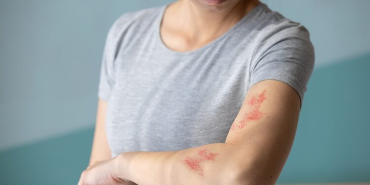 Avižinės vonios nuo niežulio dėl dilgėlinės