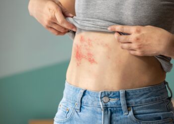 Diseminuoto juostinio pūslelinio simptomai