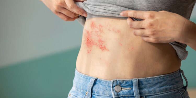 Diseminuoto juostinio pūslelinio simptomai