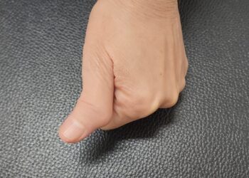 Lenkto nykščio sindromas