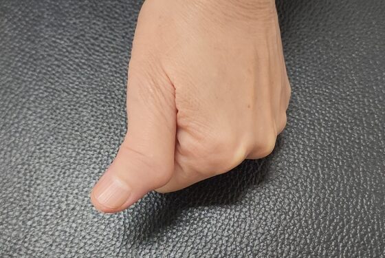 Lenkto nykščio sindromas