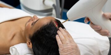 Lazerių terapija nuo plaukų slinkimo