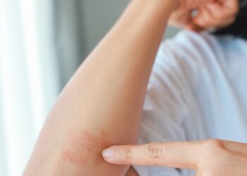 Mano saviugdos ritualai, kai paūmėja psoriazinis artritas