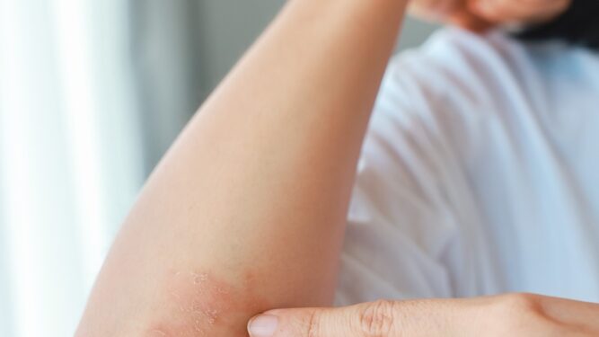 Mano saviugdos ritualai, kai paūmėja psoriazinis artritas