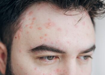 Kodėl vartojant „Rinvoq“ gali atsirasti aknė?