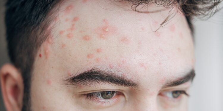 Kodėl vartojant „Rinvoq“ gali atsirasti aknė?