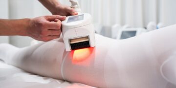 Ko tikėtis po kojų kapiliarų (voratinklinių venų) šalinimo lazeriu