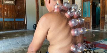 Ar akupresūros taškų terapija gali padėti gydyti erekcijos sutrikimus?