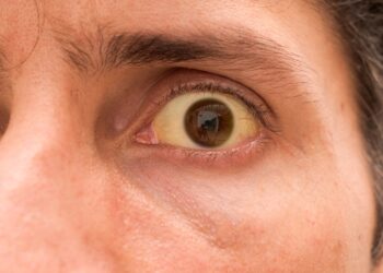 Sumažinkite akių pageltimą