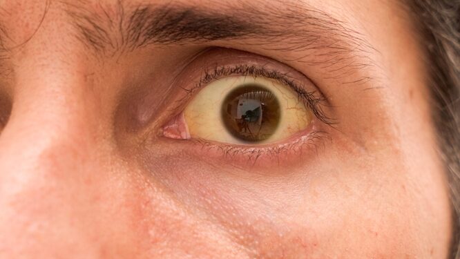 Sumažinkite akių pageltimą