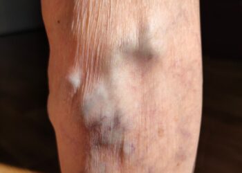 6 neįprasti arba mažiau žinomi endometriozės simptomai