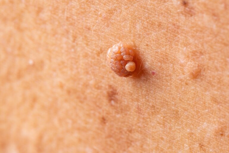Dermatofibroma