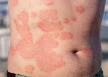 Trys žinutės, kurias išsiunčiau paūmėjus žvynelinei