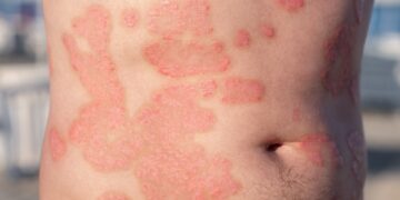 Trys žinutės, kurias išsiunčiau paūmėjus žvynelinei