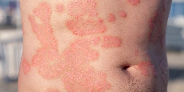 Trys žinutės, kurias išsiunčiau paūmėjus žvynelinei