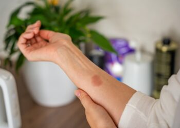 Pirmoji pagalba nudegimų atvejais