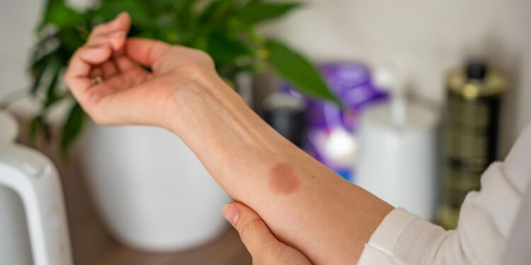 Pirmoji pagalba nudegimų atvejais