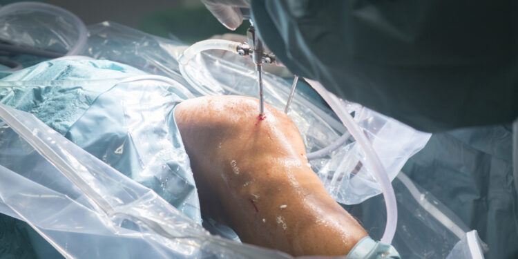 Kelio sąnario keitimo operacijos eiga