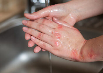 Kaip išvengti žvynelinės paūmėjimo vestuvių dieną