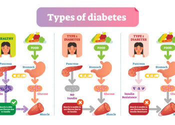 4 dalykai, kuriuos norėčiau, kad žmonės suprastų apie 2 tipo diabetą