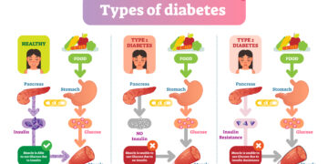 4 dalykai, kuriuos norėčiau, kad žmonės suprastų apie 2 tipo diabetą