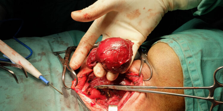 Prieskydinės liaukos adenoma