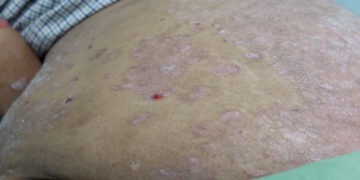 Ar žvynelinė sunkės, kai senėsiu? Ką svarbu žinoti