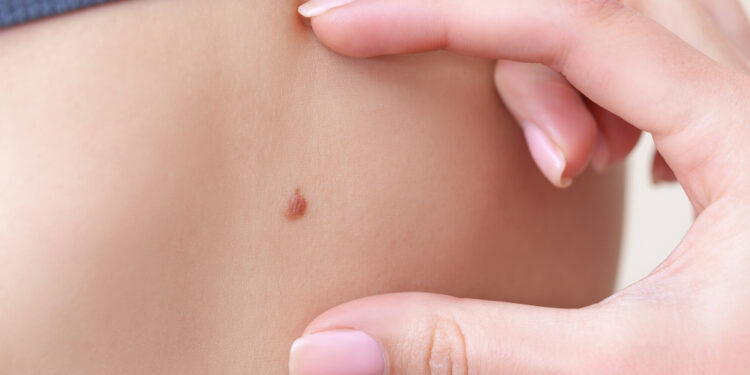 Įprasti ir netipiniai apgamai: kaip juos atskirti