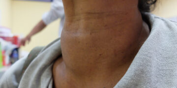 Išplitęs meduliarinis skydliaukės vėžys: požymiai ir simptomai