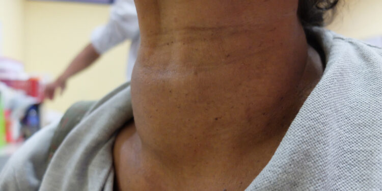 Išplitęs meduliarinis skydliaukės vėžys: požymiai ir simptomai