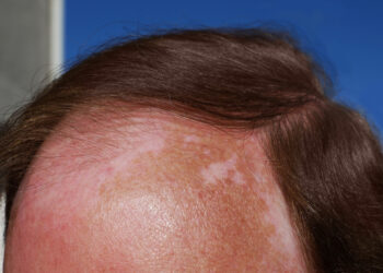 Nudegusi nuo saulės galvos oda