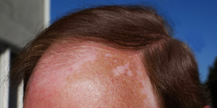 Nudegusi nuo saulės galvos oda